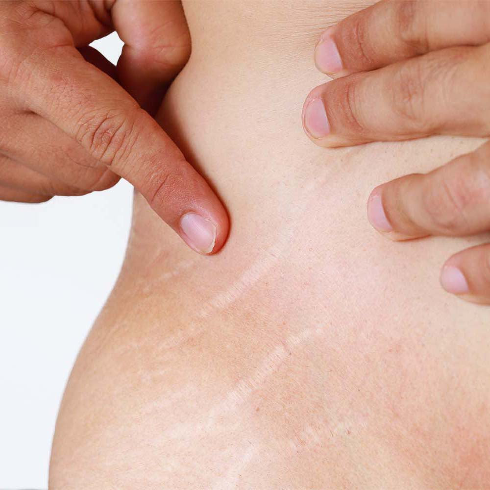 Microneedling Scar Add-On